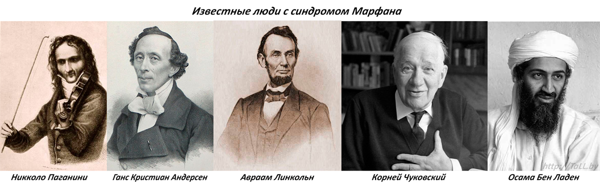 izvestnye-ludi-s-sindromom-marfana.jpg